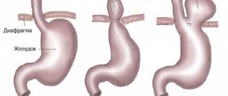 types of hiatal hernia