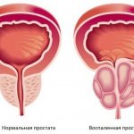 Prostate inflammation