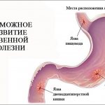 Possible development of peptic ulcer