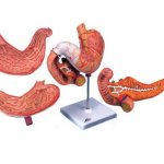 Erythematous gastritis disease