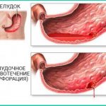 Gastric bleeding (perforation)