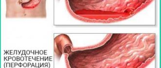 Gastric bleeding (perforation)